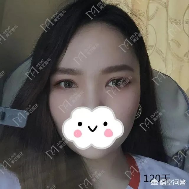 做双眼皮有几种方法？