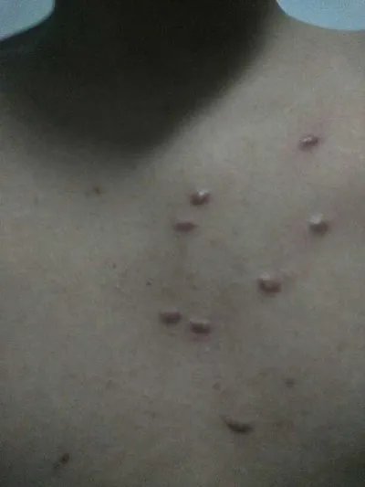 扁平尤是什么原因?