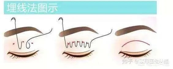 做双眼皮有几种方法？