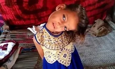 8岁女孩头部无法竖立是怎么回事?