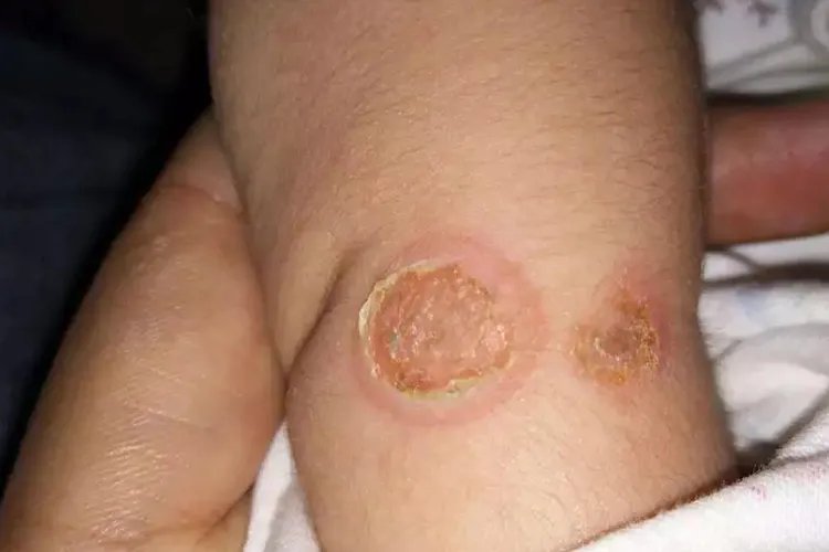 黄皮疮症状的图片