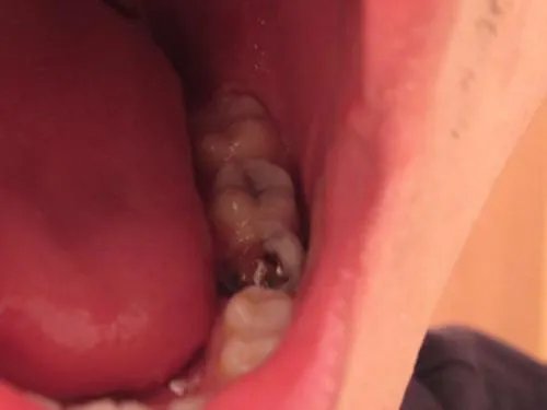 补牙需要多少钱一颗