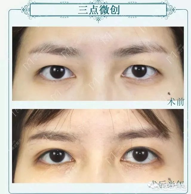 做双眼皮有几种方法？