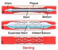 在未来,能做全身的血管支架手术吗?