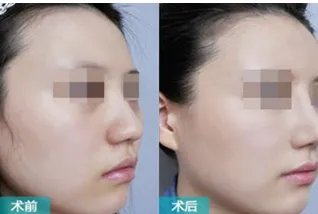 上海面部脂肪填充医院哪里好？