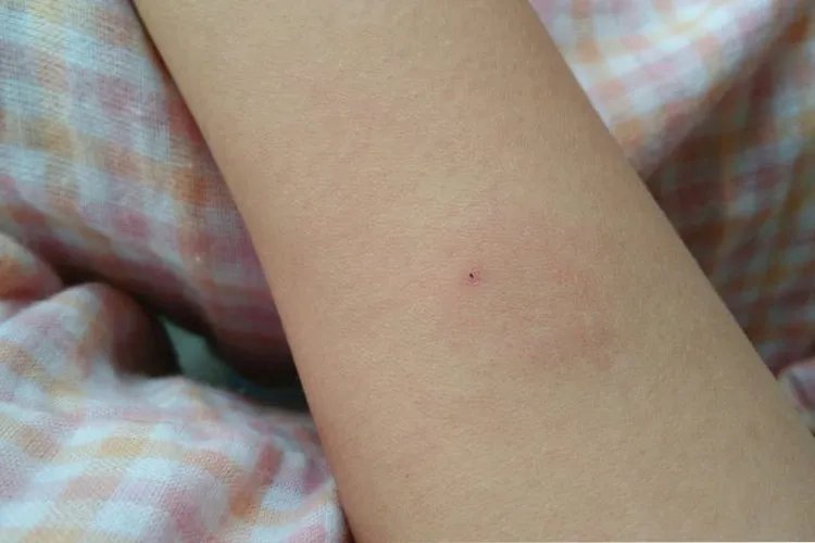 PPD硬结直径测量图解