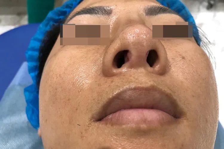 隆鼻后增生的症状图片