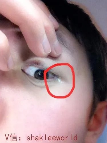 睑板腺功能障碍（MGD）,眼角白色分泌物产生，是什么原因？