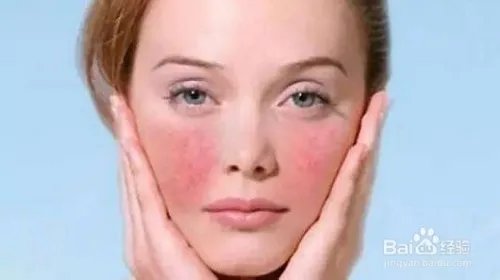 脸上的红血丝怎样处理