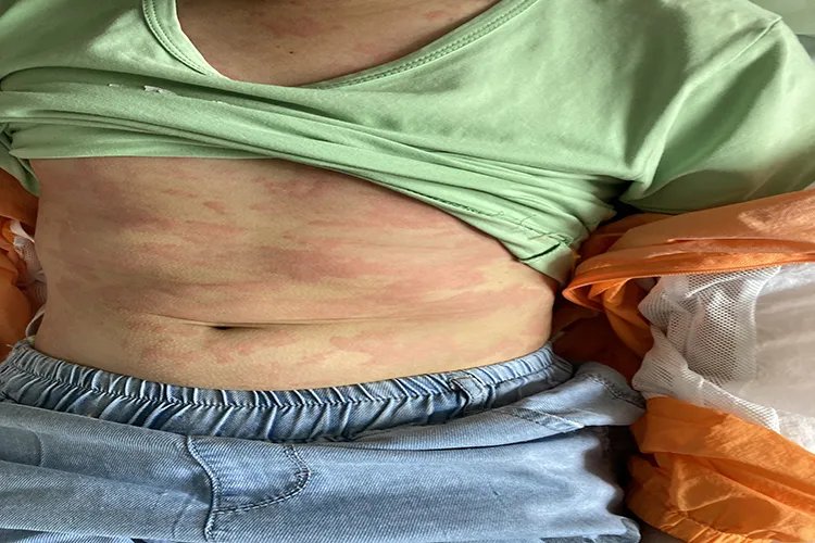 荨麻疹性皮炎症状图片