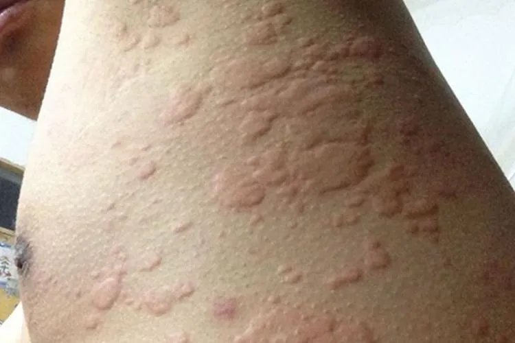 火龙果过敏症状图片大全