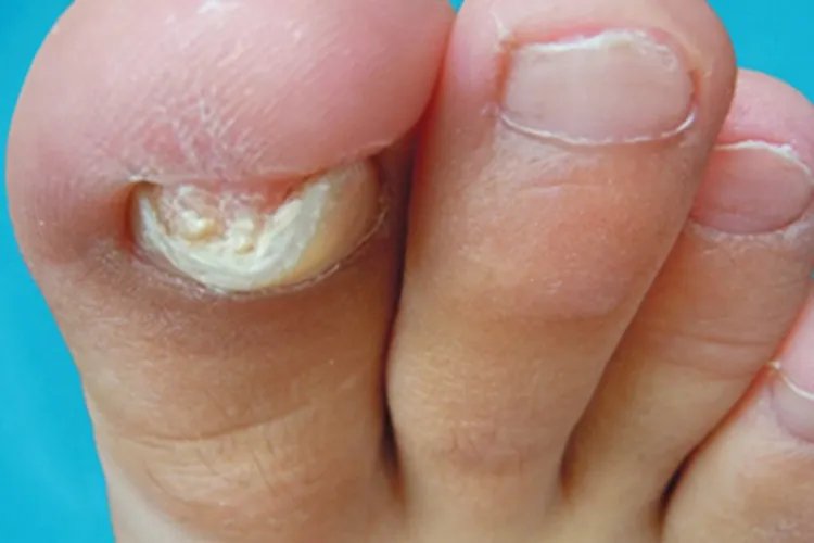 甲下外生骨疣症状图片