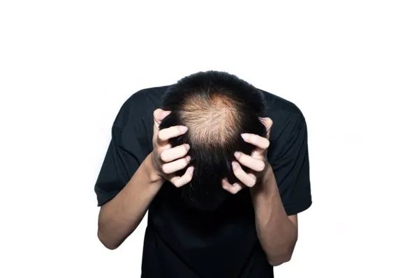 深圳看脱发大概多少钱