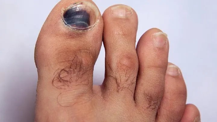 黄褐斑和雀斑多见于