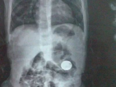 吉林一男子吃饺子误将硬币吞进肚,误食硬币该怎么办?