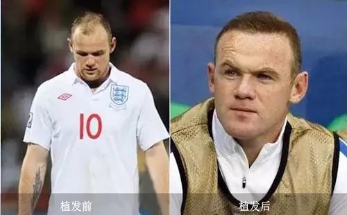 有哪些明星做过植发？