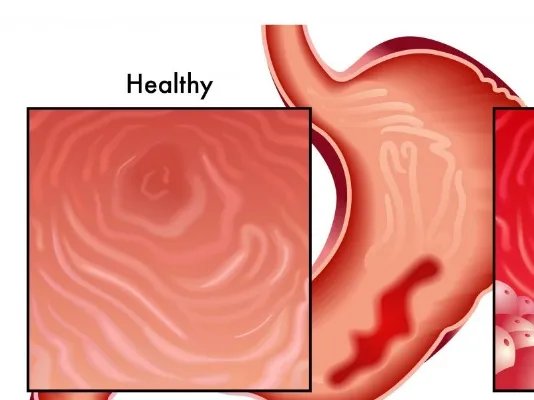 胃的左侧是什么