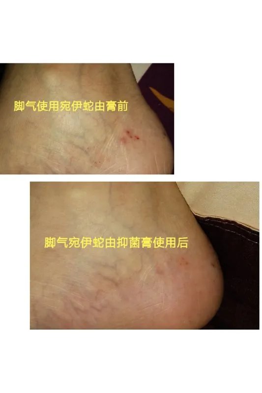 治皮肤病的乳膏都没有哪些？效果怎样？那个步步为赢生物本草抑菌乳膏含激素吗？吗？