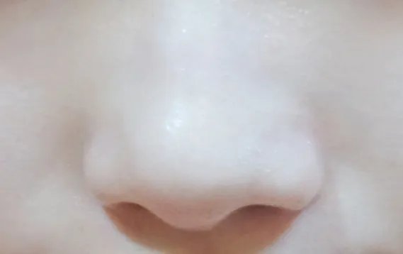 鼻子好多黑头怎么办