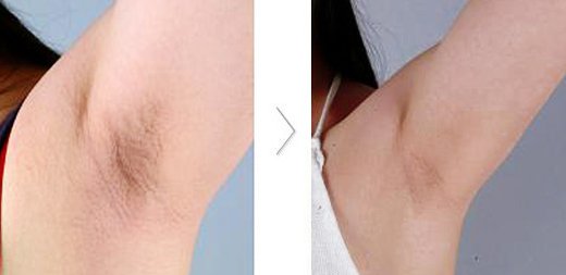 永久脱毛一般要多少钱