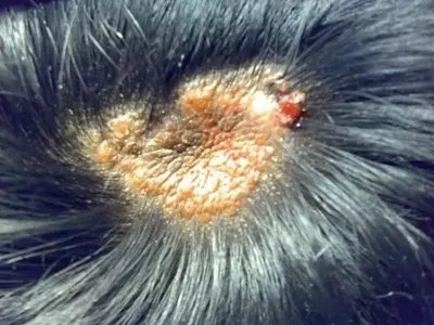 乳头状汗管囊腺瘤头皮肿块图片