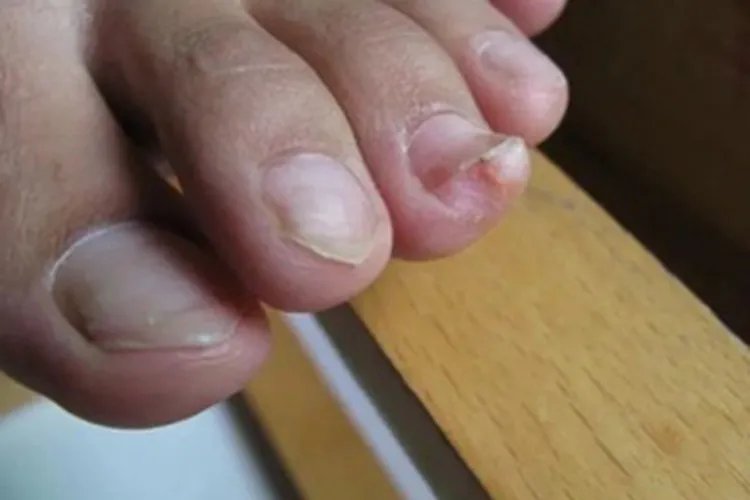 甲下外生骨疣症状图片