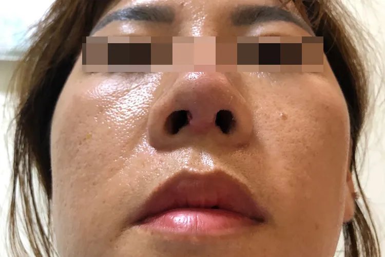 隆鼻后增生的症状图片