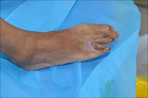 糖尿病真实图片大全