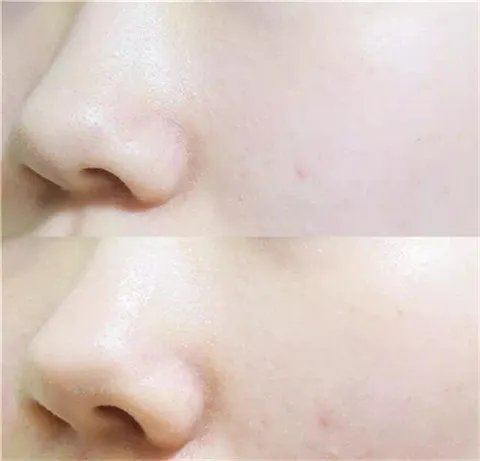 春雨面膜的功效与作用 春雨面膜有什么效果