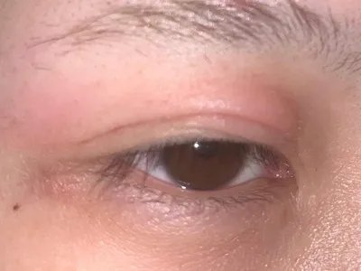 结膜炎大红疙瘩图片