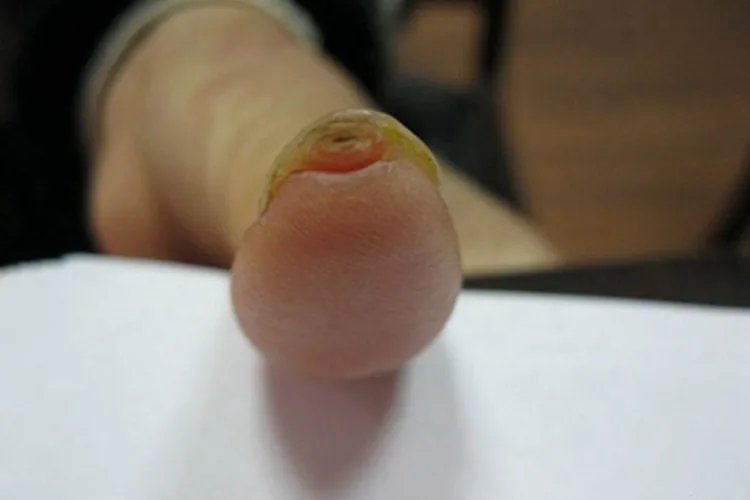 甲下外生骨疣症状图片