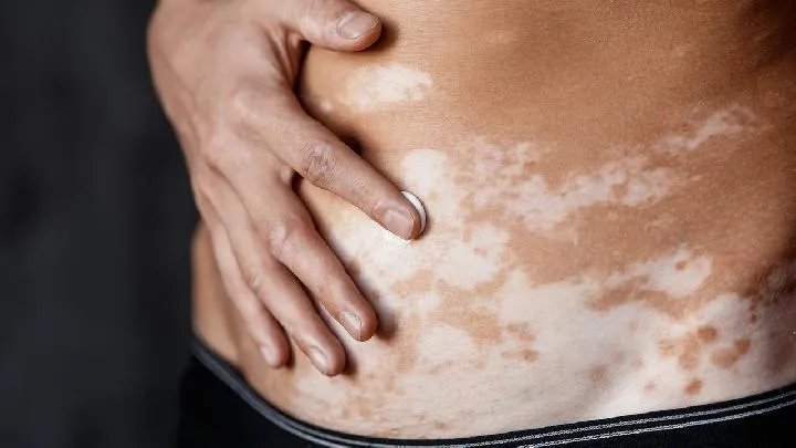 苏州白癜风医院：网购白癜风药品靠谱不