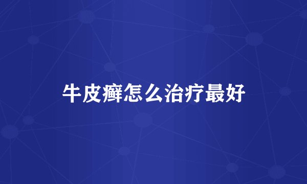 牛皮癣怎么治疗最好
