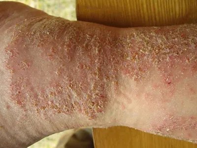 短暂性棘层松解性皮病黄痂图片