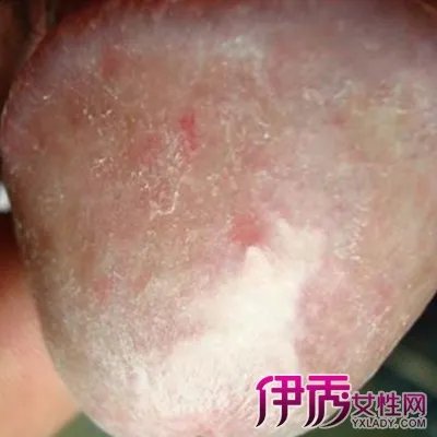 揭秘滴虫鬼头炎初期图片