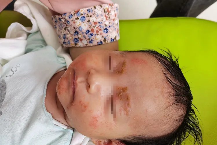 新生儿脸上长红疹子有白头图片