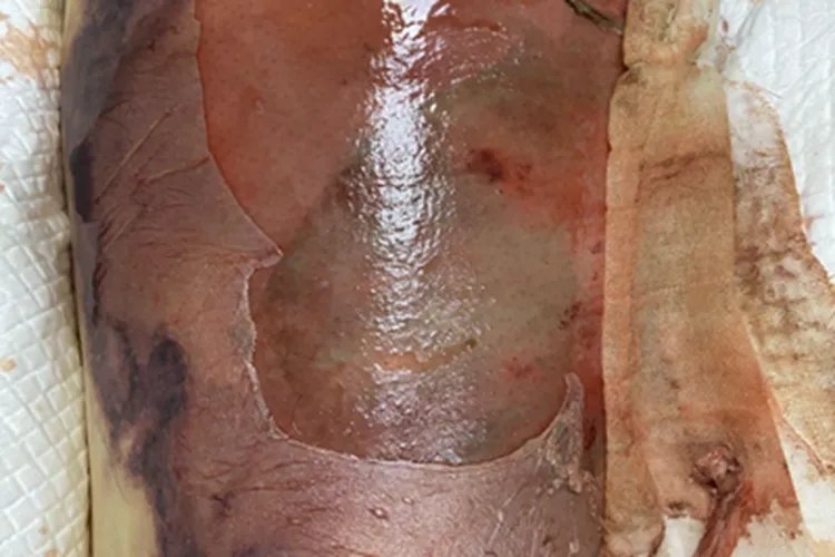 炭疽败血症症状图片