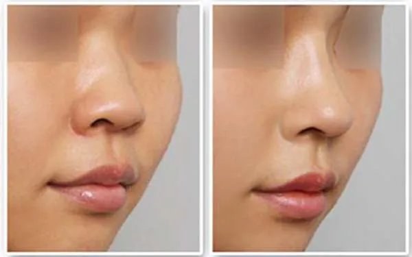 广州医院哪家做硅胶隆鼻好