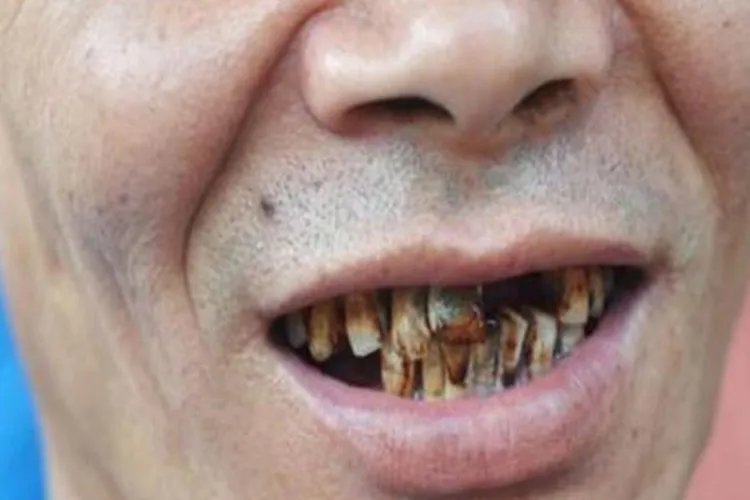 牙齿变黑的原因图片