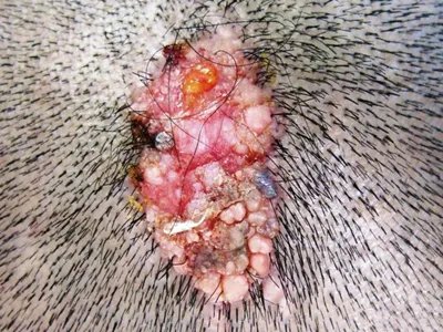 乳头状汗管囊腺瘤头皮肿块图片
