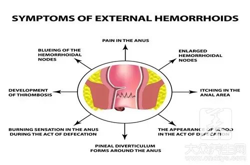 关于痔疮的四大谣言，你有相信过吗？