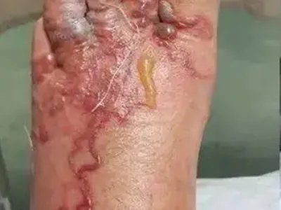 皮肤幼虫移行症脚部红肿图片