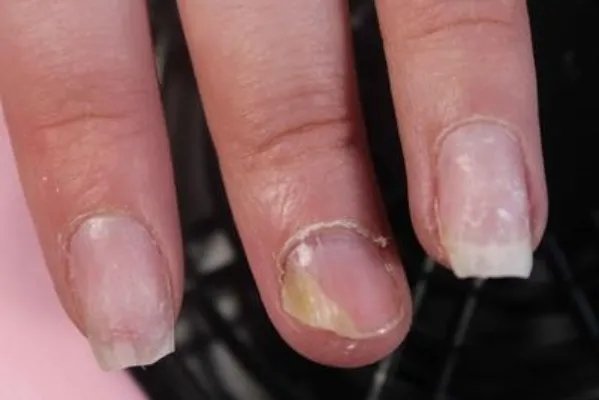 指甲上有黑色竖纹怎么办 解析治疗黑色竖纹的四种方法