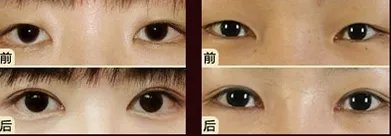 开外眼角前后对比照片图