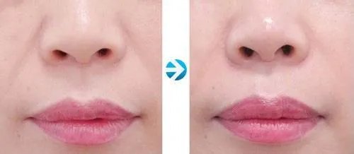 鼻唇沟填充美容术效果会不会好
