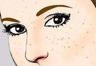 激光祛斑大概需要多少钱