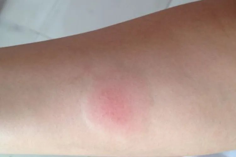 PPD硬结直径测量图解