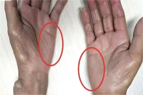 糖尿病真实图片大全